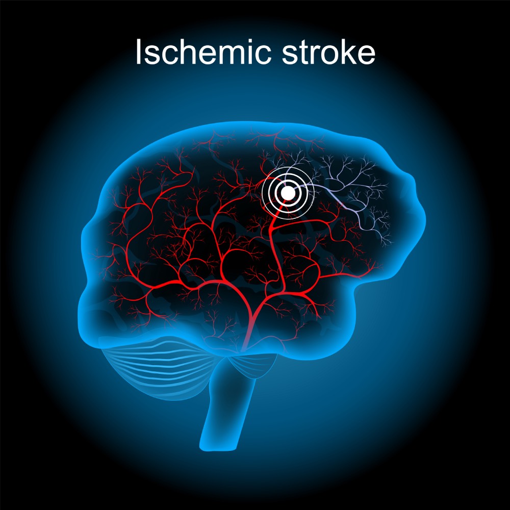 Postoperative Ischemic Stroke